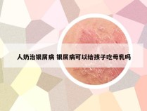 人奶治银屑病 银屑病可以给孩子吃母乳吗