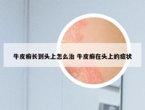 牛皮癣长到头上怎么治 牛皮癣在头上的症状