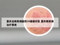 重庆治银屑病医院39健康问答 重庆银屑病治疗费用