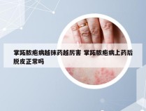 掌跖脓疱病越抹药越厉害 掌跖脓疱病上药后脱皮正常吗