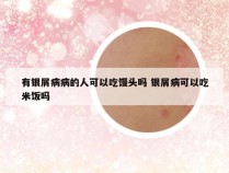 有银屑病病的人可以吃馒头吗 银屑病可以吃米饭吗