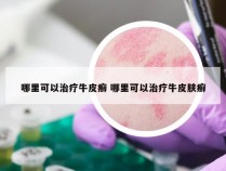 哪里可以治疗牛皮癣 哪里可以治疗牛皮肤癣
