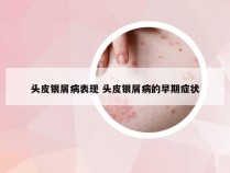 头皮银屑病表现 头皮银屑病的早期症状