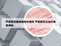 芦荟胶对银屑病有作用吗 芦荟胶可以治疗银屑病吗