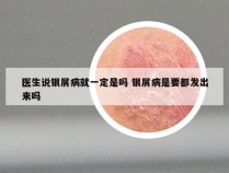 医生说银屑病就一定是吗 银屑病是要都发出来吗