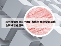 脓包性银屑病在中国的发病率 脓包型银屑病会转成普通型吗