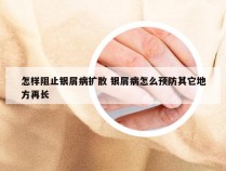 怎样阻止银屑病扩散 银屑病怎么预防其它地方再长