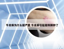 牛皮癣为什么腿严重 牛皮癣引起腿和脚肿了