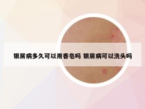 银屑病多久可以用香皂吗 银屑病可以洗头吗