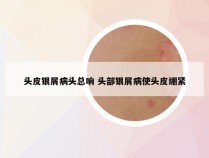 头皮银屑病头总响 头部银屑病使头皮绷紧