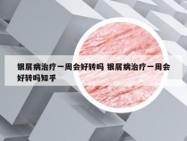 银屑病治疗一周会好转吗 银屑病治疗一周会好转吗知乎