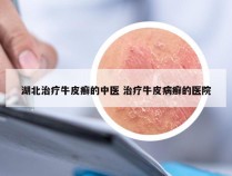 湖北治疗牛皮癣的中医 治疗牛皮病癣的医院