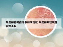 牛皮癣能喝西洋参和玫瑰花 牛皮癣喝玫瑰花茶好不好