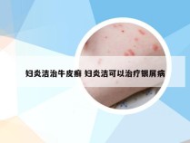 妇炎洁治牛皮癣 妇炎洁可以治疗银屑病