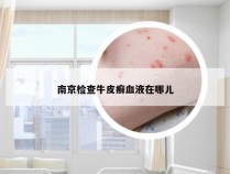 南京检查牛皮癣血液在哪儿