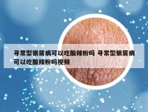 寻常型银屑病可以吃酸辣粉吗 寻常型银屑病可以吃酸辣粉吗视频