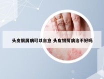 头皮银屑病可以自愈 头皮银屑病治不好吗