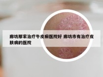 廊坊那家治疗牛皮癣医院好 廊坊市有治疗皮肤病的医院