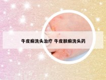 牛皮癣洗头治疗 牛皮肤癣洗头药