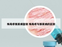 梅毒疹银屑病鉴别 梅毒疹与银屑病的区别