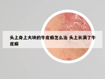 头上身上大块的牛皮癣怎么治 头上长满了牛皮癣