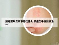 脓疱型牛皮癣不能吃什么 脓疱型牛皮肤癣治疗