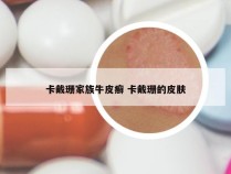 卡戴珊家族牛皮癣 卡戴珊的皮肤
