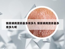银屑病用激素最多用多久 银屑病用激素最多用多久呢