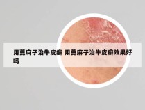 用蓖麻子治牛皮癣 用蓖麻子治牛皮癣效果好吗