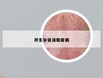 开玄补肾汤银屑病