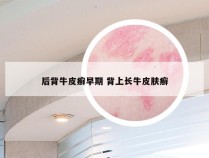 后背牛皮癣早期 背上长牛皮肤癣