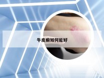 牛皮癣如何能好