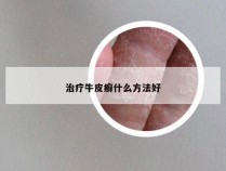 治疗牛皮癣什么方法好