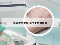 鼻尖有牛皮癣 鼻子上的银屑病