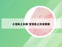小宝身上长癣 宝宝身上长皮肤癣