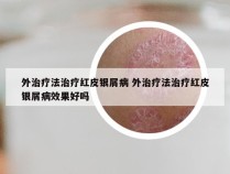 外治疗法治疗红皮银屑病 外治疗法治疗红皮银屑病效果好吗