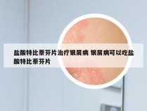 盐酸特比萘芬片治疗银屑病 银屑病可以吃盐酸特比萘芬片