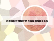 白殿疯好转图片欣赏 白殿疯病情能活多久