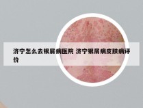 济宁怎么去银屑病医院 济宁银屑病皮肤病评价
