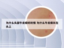 为什么头部牛皮癣好的慢 为什么牛皮癣长在头上
