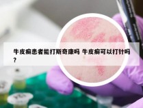 牛皮癣患者能打斯奇康吗 牛皮癣可以打针吗?