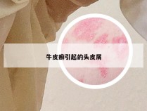 牛皮癣引起的头皮屑