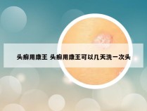 头癣用康王 头癣用康王可以几天洗一次头
