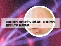 郑州市那个医院治疗皮肤病最好 郑州市哪个医院治疗皮肤病最好