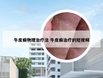 牛皮癣物理治疗法 牛皮癣治疗的短视频