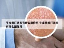 牛皮癣打激素有什么副作用 牛皮肤癣打激素有什么副作用