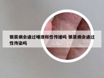 银屑病会通过唾液和性传播吗 银屑病会通过性传染吗