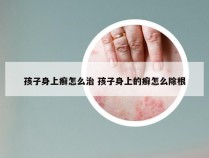 孩子身上癣怎么治 孩子身上的癣怎么除根