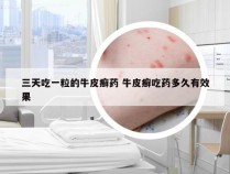 三天吃一粒的牛皮癣药 牛皮癣吃药多久有效果