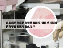 银屑病初期症状有哪些表现呢 银屑病初期症状有哪些表现呢怎么治疗